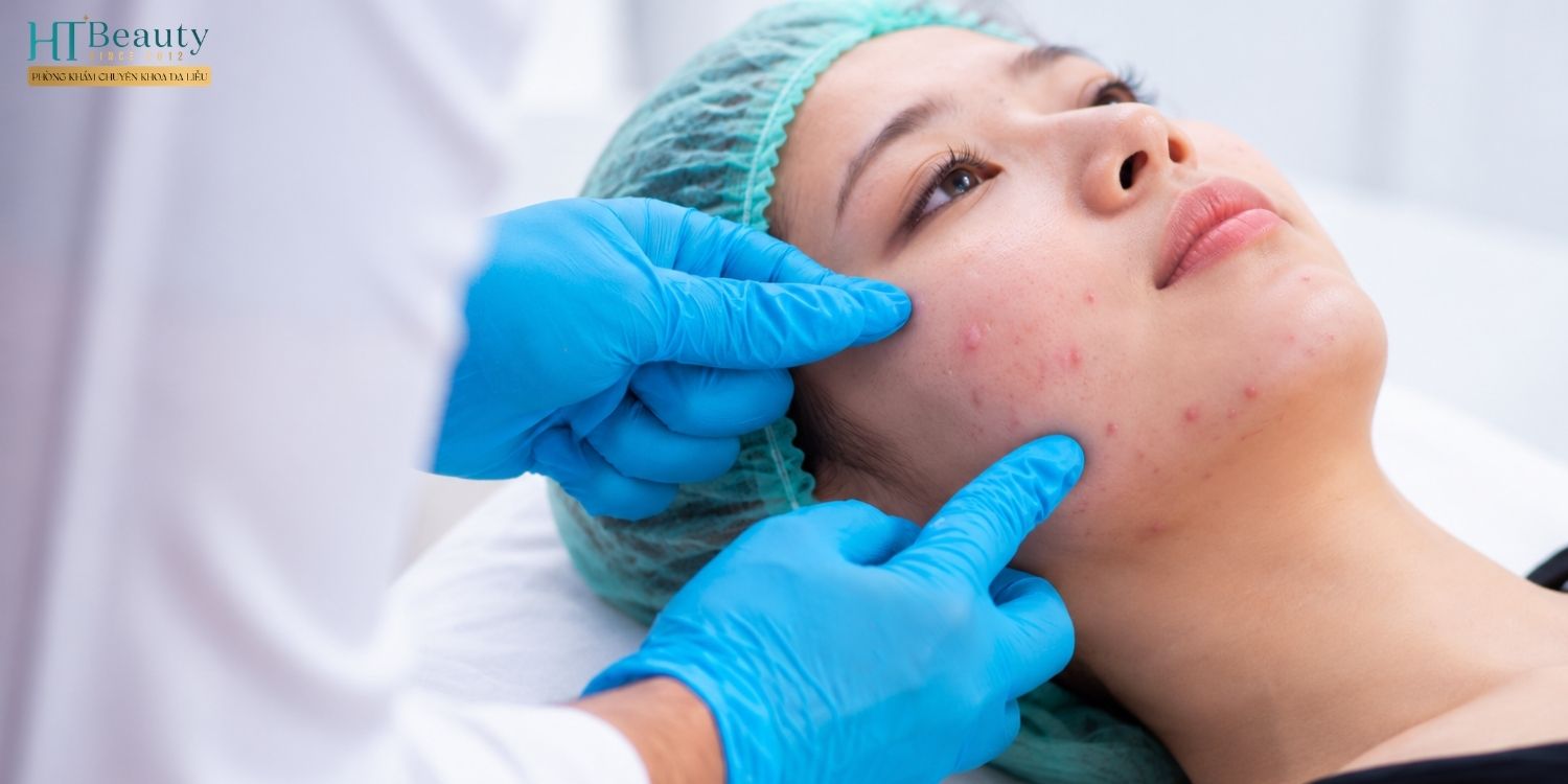 Điều trị mụn nội tiết tại Phòng khám da liễu
