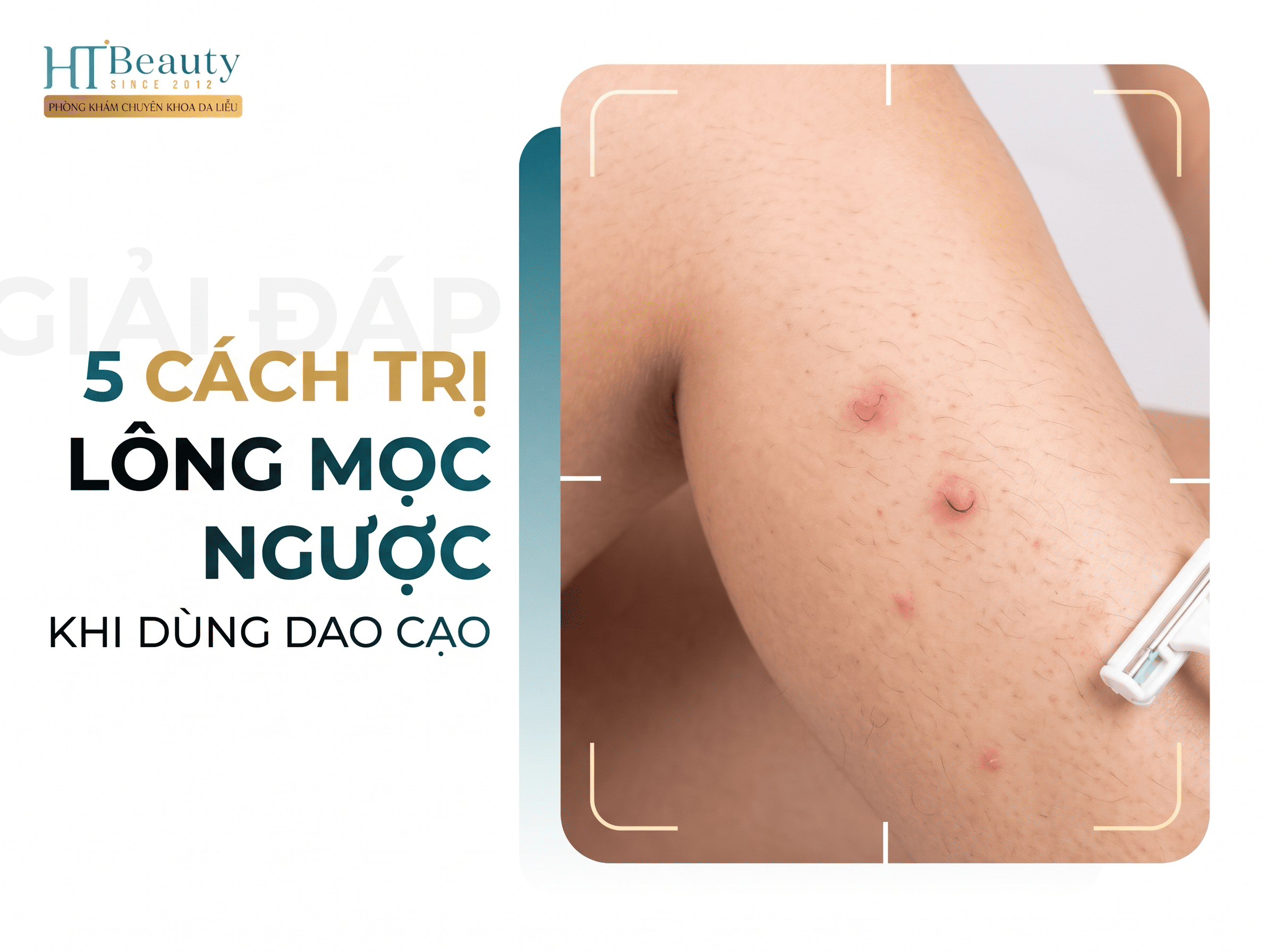 Trị lông mọc ngược